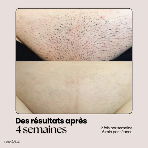 HelloBabe IPL Pro · Épilateur à lumière pulsée corps et visage